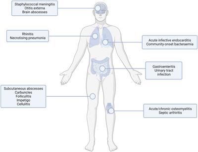 The immune evasion roles of Staphylococcus aureus protein A and impact on vaccine development